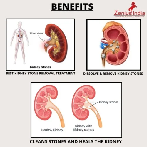 Zenius India Stonil  Capsulesule For Kidney Stone Removal (60cap)
