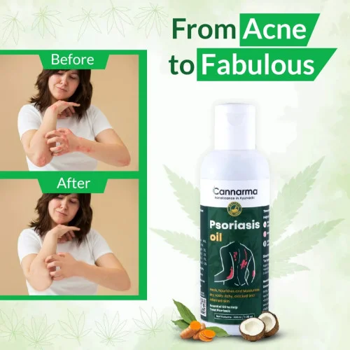 Cannarma Psoriasis Oil (100ml)