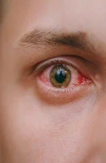 Conjunctivitis