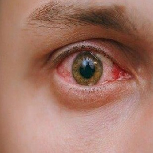 Conjunctivitis