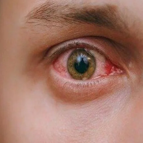 Conjunctivitis