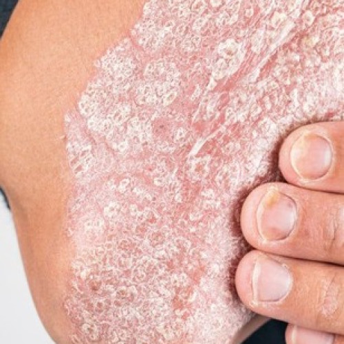 Psoriasis & Dry Skin
