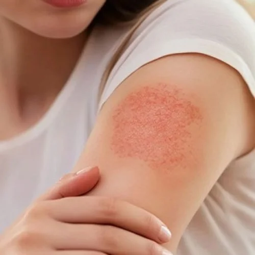 Rash/Itch/Urticaria/Hives