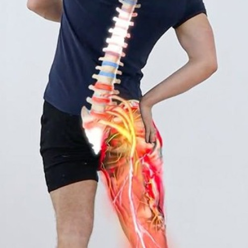 Sciatica