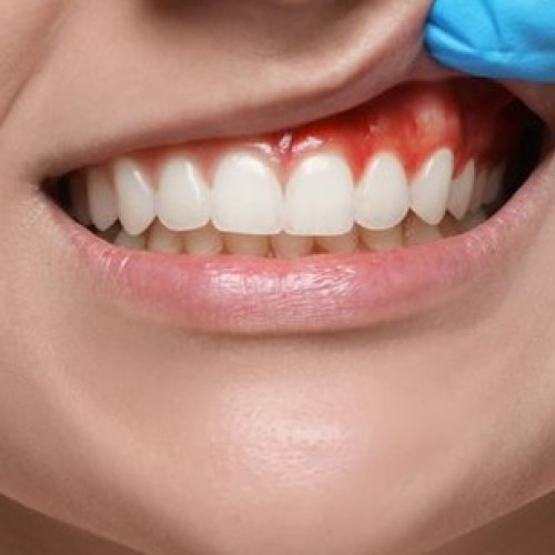 Bleeding Gum/Pyorrhoea