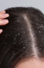 Dandruff