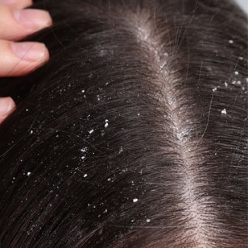 Dandruff
