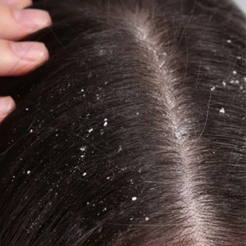 Dandruff